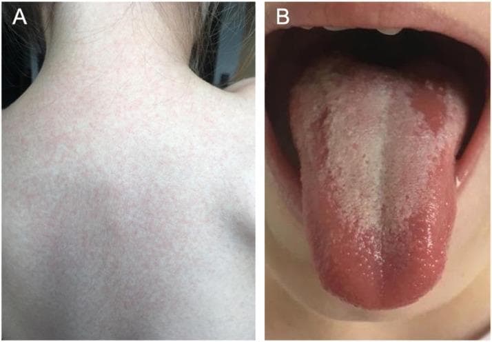A composite of two clinical photographs (A and B) demonstrating classic physical manifestations of scarlet fever (Scarlatina) in a pediatric patient. Image A displays a characteristic scarlatiniform rash on the posterior trunk and neck. The rash is composed of diffuse, fine, erythematous maculopapular lesions that are closely spaced, giving the skin a 'sandpaper' texture. Image B shows an intraoral view of the tongue, illustrating 'white strawberry tongue.' The dorsal surface is covered by a thick, yellowish-white coating through which enlarged, hyperemic fungiform papillae project as prominent red dots. The lateral borders and the tip of the tongue appear intensely erythematous. These findings are hallmarks of a Group A Streptococcus infection. This educational material is suitable for illustrating systemic pediatric infections and dermatological-oral correlations in infectious diseases.