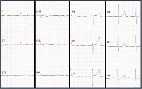 A standard twelve-lead electrocardiogram (ECG) demonstrating atrial fibrillation. The tracing is organized into four columns representing limb leads (I, II, III), augmented leads (aVR, aVL, aVF), and precordial leads (V1-V3 and V4-V6). The primary diagnostic feature is a 'highly irregular' rhythm with variable R-R intervals, indicating an irregular ventricular response. There is a complete absence of organized P waves across all leads, which are replaced by fine, erratic baseline fluctuations known as fibrillatory (f) waves, most visible in leads II and V1. The QRS complexes are narrow, suggesting normal intraventricular conduction. Notably, the limb leads (specifically I, II, III, aVF) exhibit low voltage QRS complexes, which is a classic electrophysiological finding in cardiac amyloidosis, often contrasting with the increased myocardial wall thickness seen on imaging. This ECG serves as a clinical example of supraventricular arrhythmia in the context of systemic infiltrative disease, such as wild-type ATTR amyloidosis.