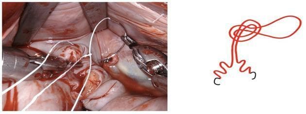 This educational graphic consists of a clinical photograph and a corresponding schematic diagram illustrating a surgical suturing technique. The left panel shows an intraoperative clinical photograph of a surgical site, likely involving cardiac or thoracic tissue, characterized by moist, vascular surfaces and blood. Metal retractors and laparoscopic graspers are visible, manipulating a white monofilament suture. The suture is being passed through a pre-fashioned loop to anchor the starting point without the need for traditional hand-tied knots, an efficiency technique often used in minimally invasive or robotic surgery. The right panel provides a red-line schematic representation of the 'loop-and-pass' anchoring mechanism. It depicts the suture line forming an initial circular loop knot at the top, followed by a parallel descent that branches into two wavy distal segments tipped with black needle indicators. This visual pair serves to teach surgical residents and clinicians about knotless anchoring methods that can reduce operative time and improve technical consistency during complex reconstructive procedures.