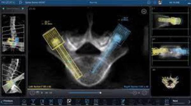 This diagnostic image displays the software interface for the Mazor X robotic guidance system used in preoperative spinal surgical planning. The central panel features a transverse (axial) CT scan reconstruction of a lumbar vertebra, showing the vertebral body, pedicles, lamina, and spinous process. Overlaid on the anatomy are color-coded graphical representations of pedicle screws: a yellow screw on the left and a blue screw on the right. These 3D models demonstrate the planned trajectory, diameter, and insertion depth through the pedicles into the vertebral body. Additional peripheral panels provide multiplanar views, including a sagittal reconstruction of the spine on the left and specialized coronal and side-view alignments on the right. The interface facilitates optimization of construct definition, allowing surgeons to select appropriate screw dimensions based on individual patient anatomy. This visual illustrates the integration of advanced medical imaging with robotic navigation for spinal instrumentation.