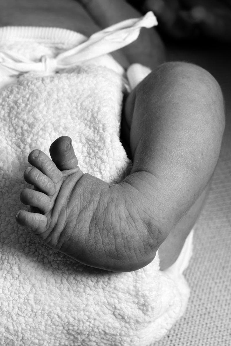 A grayscale clinical photograph of an infant's foot and lower leg demonstrating Congenital Talipes Equinovarus (CTEV), commonly known as clubfoot. The image captures the foot in a characteristic position of adduction, inversion, and plantarflexion. Key anatomical features include a distinctly rounded lateral border of the foot and a poorly defined, soft-appearing heel. The dorsum of the foot and the ankle region exhibit prominent deep skin creases and transverse folds, which are classic clinical markers of this deformity. The toes appear relatively short and fan out slightly from the metatarsophalangeal joints. This photograph is used for educational purposes to illustrate the physical signs of clubfoot and the associated challenges in anatomical landmark identification for clinical measurement and diagnosis in pediatric orthopedics.