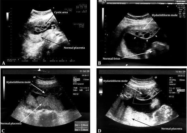 This obstetric ultrasound series (A-D) captures a rare twin pregnancy consisting of a complete hydatidiform mole and a coexisting viable fetus, spanning from 15 to 28 weeks of gestation. Image A (15 weeks) reveals a distinct cystic area at the anterior uterine wall characterized by multiple small, sonolucent vesicles, clearly separated from a homogeneous normal placenta. Image B (18 weeks) illustrates the characteristic heterogeneous, 'grape-like' vesicular echotexture of the hydatidiform mole situated superiorly, while a viable fetus with distinct anatomical outlines is visible inferiorly. Images C (24 weeks) and D (28 weeks) demonstrate the progression of the condition, showing the persistent, complex multicystic structure of the mole alongside the developing normal placenta and fetus. The series emphasizes the diagnostic hallmark of this condition: the presence of two distinct placental tissues—one with normal echogenicity and one exhibiting the disorganized, hydropic villi typical of molar pregnancy. This visual progression is critical for differentiating between a partial mole and a twin pregnancy with a complete mole and a coexistent live fetus.