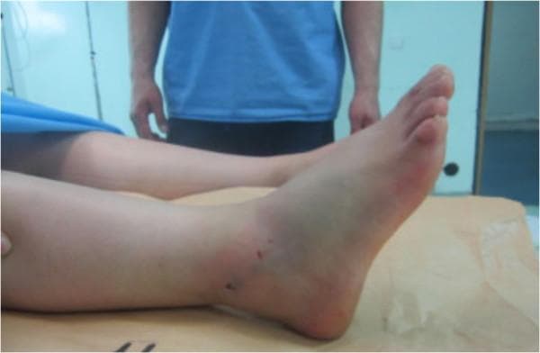 This clinical photograph shows a lateral view of a patient's right lower leg and foot following the reduction of a medial subtalar dislocation. The image demonstrates significant soft tissue swelling (edema) localized around the ankle joint and the distal third of the lower leg, resulting in a loss of normal bony landmarks such as the lateral malleolus. The foot is positioned in a state of moderate plantar flexion. On the anterolateral aspect of the ankle and lower leg, several small, punctate dark red marks are visible, consistent with minor skin abrasions or puncture wounds sustained during the traumatic event. Faint ecchymosis (bruising) is also noted near the posterior aspect of the heel. The overall alignment appears improved compared to a pre-reduction state, though the diffuse swelling masks deep anatomical definition. This image serves as a clinical example of post-reduction monitoring for high-energy ankle trauma and associated soft tissue injury in an emergency or orthopedic setting.