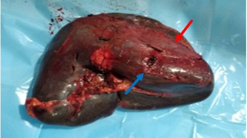Clinical photograph of a gross pathological specimen showing an enlarged, splenomegalic spleen post-emergency splenectomy. The organ displays a dark, reddish-purple discoloration and irregular surface texture consistent with hematologic pathology. A prominent 3 cm parenchymal laceration at the lower pole is indicated by a blue arrow, representing a traumatic or spontaneous grade three splenic injury. A red arrow identifies a ruptured subcapsular hematoma, appearing as an extensive, raised, lighter red mass covering more than 50% of the organ's surface. This specimen illustrates complications of splenomegaly, often secondary to conditions like Chronic Myeloid Leukemia (CML), where increased organ friability raises the risk of spontaneous rupture, hemorrhage, and subsequent hemoperitoneum.