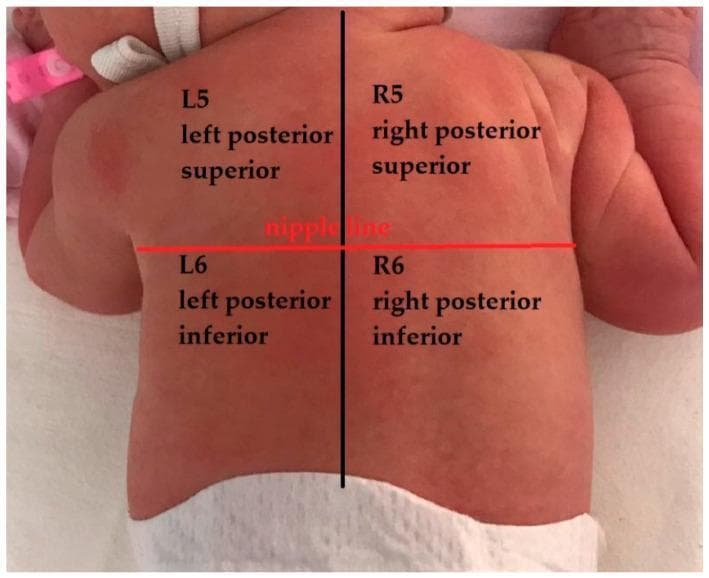 This clinical photograph demonstrates an anatomical mapping of the posterior thorax in a neonate, used specifically for standardized lung ultrasound (LUS) examination. The infant is positioned prone, and the back is divided into four distinct diagnostic zones by two intersecting axes. A vertical black line bisects the back into left and right hemithoraces. A horizontal red line, labeled 'nipple line,' serves as the anatomical landmark to differentiate the superior and inferior segments. The resulting four zones are labeled as follows: L5 (left posterior superior), L6 (left posterior inferior), R5 (right posterior superior), and R6 (right posterior inferior). This visual guide is part of a 12-zone lung ultrasound scoring system designed to semi-quantify pulmonary pathology, such as consolidations or B-lines, in pediatric and neonatal patients. The mapping provides a systematic approach for clinicians to assess and document lung findings consistently across different regions of the posterior chest wall.