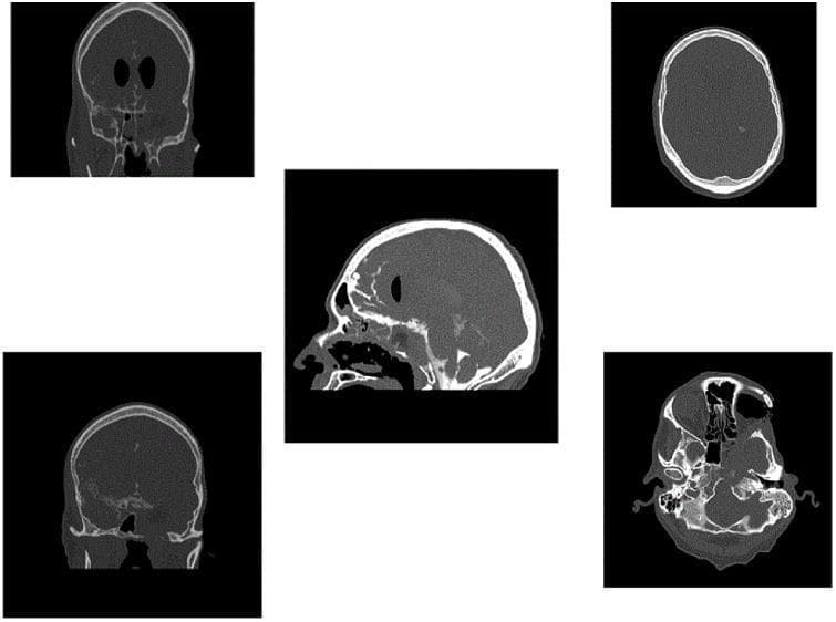 This set of diagnostic images consists of multiple Computed Tomography (CT) cisternogram views (coronal, axial, and sagittal) of the skull and facial bones. The images demonstrate status post-extensive surgical intervention for tumor resection and orbital exenteration. Key findings include a large bony defect in the left anterior cranial fossa and orbital region. The coronal and axial views show the absence of normal left orbital architecture and soft tissue contents, consistent with orbital exenteration. There is evidence of a transorbital and transnasal surgical approach, with disruption of the ethmoid and sphenoid sinuses to accommodate a pedicled nasoseptal flap and dermal fat graft for reconstruction of the skull base. The sagittal view highlights the discontinuity of the frontal bone and sphenoid sinus complex. High-density contrast material is visible within the subarachnoid space and basal cisterns without evidence of active extravasation, confirming a successful repair of a high-flow cerebrospinal fluid (CSF) leak. Bony margins appear irregular, indicating post-operative remodeling and surgical reconstruction.