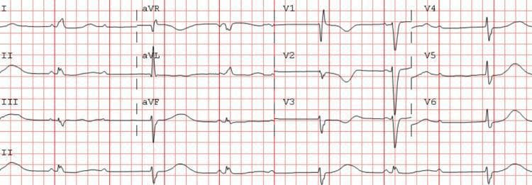 This diagnostic image is a standard 12-lead electrocardiogram (ECG) displayed on a red grid background, illustrating a complex cardiac arrhythmia. The tracing demonstrates sinus bradycardia with a high-grade atrioventricular (AV) block. Key diagnostic features include the presence of clear P waves that occur at a regular atrial rate; however, not every P wave is followed by a QRS complex, indicating failure of conduction through the AV node. Specifically, the tracing shows patterns of 2:1 Mobitz type II second-degree AV block. There is an observed irregular ventricular rhythm with occasional ventricular escape beats characterized by wider QRS morphologies compared to conducted beats. Notable features include a consistent PR interval in the conducted beats and a prolonged QTc interval. All 12 leads (I, II, III, aVR, aVL, aVF, V1-V6) are visible, providing a comprehensive view of the cardiac conduction disturbance. This ECG is representative of a clinical scenario involving syncope and high-grade heart block in an elderly patient, emphasizing the educational concepts of AV nodal disease and bradyarrhythmia management.