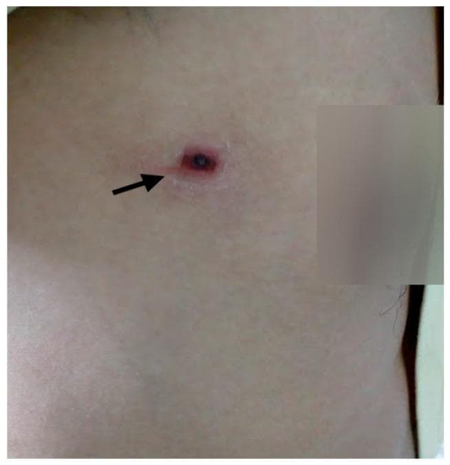 A clinical photograph of a human chest area demonstrating a pathognomonic eschar, a classic skin lesion associated with scrub typhus. The lesion, indicated by a black arrow, features a small, dark, necrotic central crust (eschar) that is circular to oval in shape. This necrotic center is surrounded by a prominent, well-demarcated erythematous halo and a slightly raised, indurated rim, characteristic of an inflammatory reaction at the site of a mite bite (chigger). The surrounding fair skin appears otherwise unremarkable without diffuse rash or additional lesions. This image serves as a key diagnostic educational tool for infectious disease and dermatology, illustrating the hallmark physical finding used in the clinical diagnosis of Orientia tsutsugamushi infection.