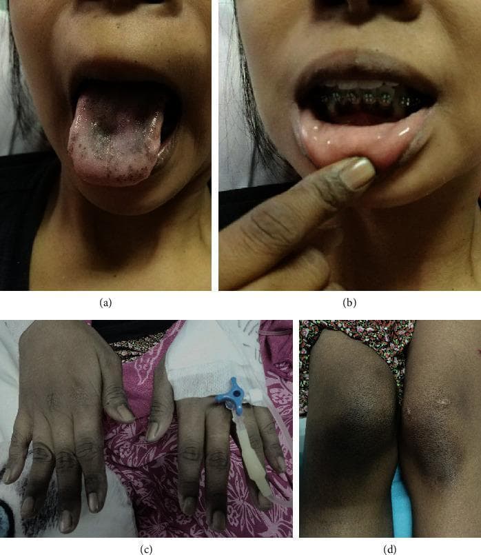 This set of clinical photographs illustrates the hallmark signs of primary adrenal insufficiency (Addison's disease), characterized by generalized mucocutaneous hyperpigmentation. Panel (a) shows significant hyperpigmentation of the tongue, presenting as dark, irregular macules and diffuse speckling primarily on the dorsal surface, accompanied by a faint whitish plaque. Panel (b) depicts mucosal hyperpigmentation of the gingiva and inner lip. Panel (c) demonstrates diffuse hyperpigmentation of the hands, with notable darkening over the extensor surfaces of the interphalangeal joints (knuckle hyperpigmentation), while the nail beds appear spared. Panel (d) shows similar localized hyperpigmentation over the knees. These visual findings result from increased levels of adrenocorticotropic hormone (ACTH) and its precursor, pro-opiomelanocortin, which stimulate melanocytes via alpha-melanocyte-stimulating hormone receptors. This presentation is essential for the clinical diagnosis of chronic adrenal cortical failure and differentiates primary from secondary adrenal insufficiency.