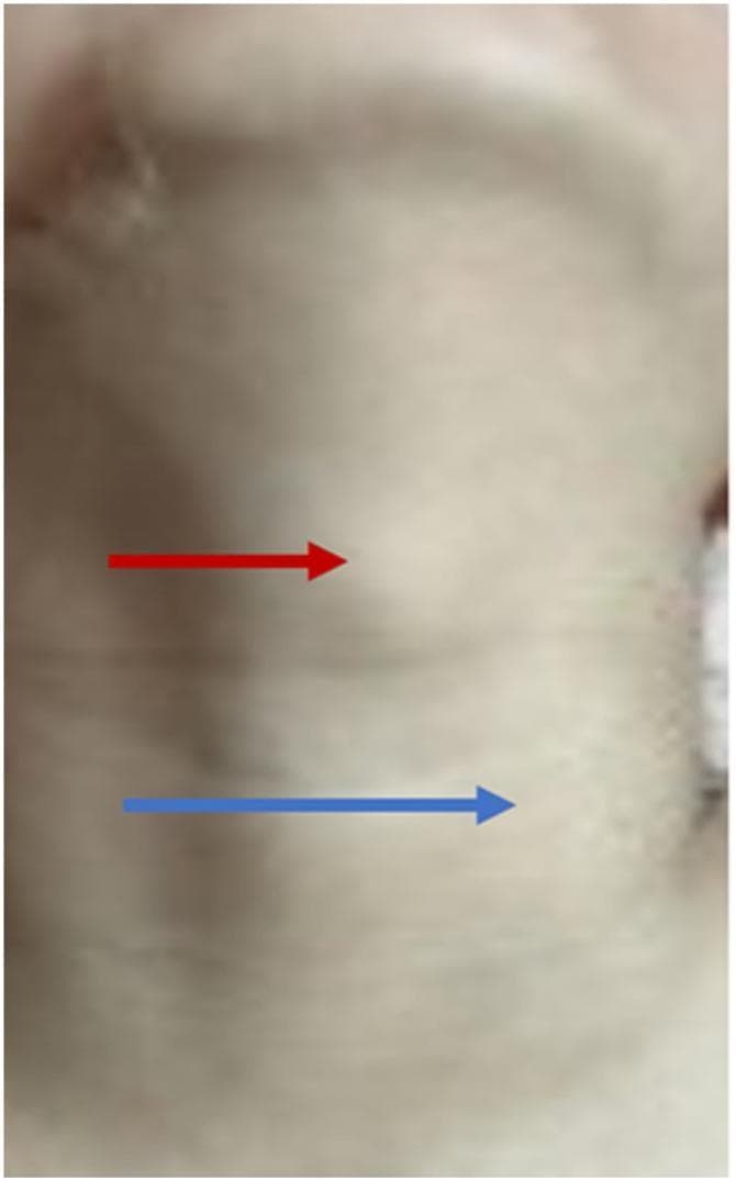 This clinical photograph displays the anterior and lateral neck of a 7-year-old patient, highlighting two distinct areas of subcutaneous swelling. A red arrow indicates a midline mass located in the infrahyoid region, specifically between the thyroid and cricoid cartilages; clinically, this represents a thyroglossal duct cyst. A blue arrow points to a second, more lateral protrusion situated anterior to the left carotid artery, which represents ectopic thymic tissue with cyst formation (thymic ectasia). The overlying skin appears normal, with no evidence of erythema, inflammation, or ulceration. This image is an educational example of concurrent congenital neck masses, illustrating the clinical presentation of a common midline lesion (thyroglossal cyst) alongside a rarer lateral developmental anomaly (ectopic thymus). It is intended for pediatric surgery and otolaryngology training to aid in the differential diagnosis of pediatric neck masses.