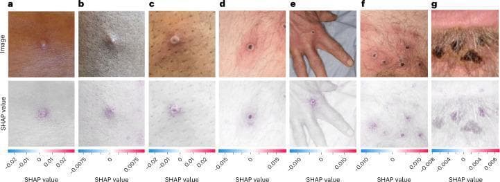 A clinical comparison chart and diagnostic visualization illustrating the progression of mpox (MPXV) skin lesions. The top row features seven photographic images (a-g) documenting the dermatological evolution: an early-stage vesicle (a), a small pustule (b), an umbilicated pustule with a central depression (c), a papule with central necrosis (d), an ulcerated lesion on a hand (e), multiple ulcerated lesions in a pubic region (f), and late-stage crusted plaques (g). The lesions exhibit characteristic features of orthopoxvirus infection, including perilesional erythema and central umbilication. The bottom row displays a corresponding SHAP (SHapley Additive exPlanations) analysis overlaid on each image. Positive SHAP values (indicated in red/purple) represent discriminative regions—specifically the primary lesions and surrounding inflammatory areas—used by a convolutional neural network (CNN) for diagnostic classification. Negative SHAP values (in blue) highlight healthy skin areas that detract from the viral prediction. This image serves as a clinical reference for disease staging and AI-assisted diagnostic transparency in infectious disease management.