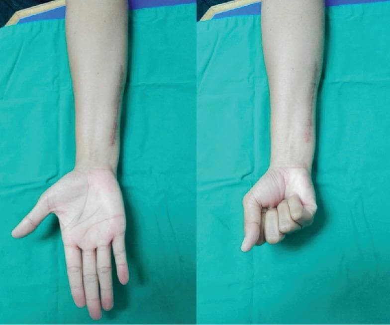 Clinical photograph of a right forearm and hand presented in two side-by-side views demonstrating post-operative recovery of motor function. The images show the volar (palmar) aspect of the extremity. On the ulnar side of the distal forearm, a well-healed, linear surgical scar is visible, corresponding to a previous ulnar shortening osteotomy site. The left panel illustrates the hand in an extended position with fingers abducted, demonstrating successful active extension and preservation of the palmar architecture. The right panel shows the hand flexed into a complete, tight fist, indicating full recovery of the flexor digitorum superficialis and profundus tendon functions. There is no evidence of residual edema, erythema, or visible deformity such as the 'claw hand' associated with ulnar nerve palsy. This clinical visual serves as an educational example of functional restoration following revision surgery and hardware replacement (titanium for stainless steel) in the context of metal hypersensitivity.