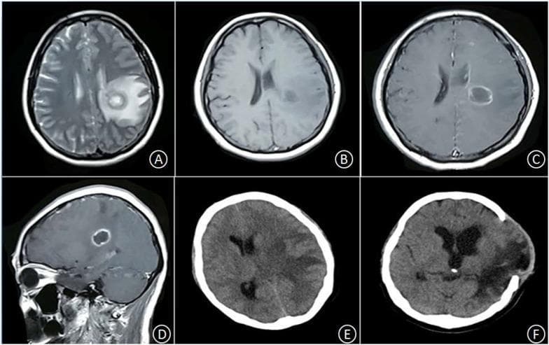 This series of neuroimaging scans demonstrates the progression and surgical resolution of a brain abscess in the left basal ganglia. Images A and B (axial T2-weighted and T1-weighted MRI) show a circular, space-occupying lesion characterized by long T1 and T2 signals, surrounded by extensive vasogenic edema in the parenchyma. Images C (axial) and D (sagittal) are post-contrast T1 MRI scans revealing classic smooth, thin ring enhancement of the abscess wall with a central non-enhancing core. Image E is an axial non-contrast CT scan taken 12 hours later, showing rapid progression of perilesional edema, significant compression of the left ventricle, and an increased rightward midline shift indicating mass effect and potential herniation risk. Image F is a post-operative axial CT scan five weeks following lesion resection and decompressive craniotomy; it shows the absence of the abscess, a persistent area of low-density encephalomalacia and edema, and restoration of the midline structures. The sequence highlights the diagnostic features of pyogenic brain abscesses and their associated neurological emergencies.