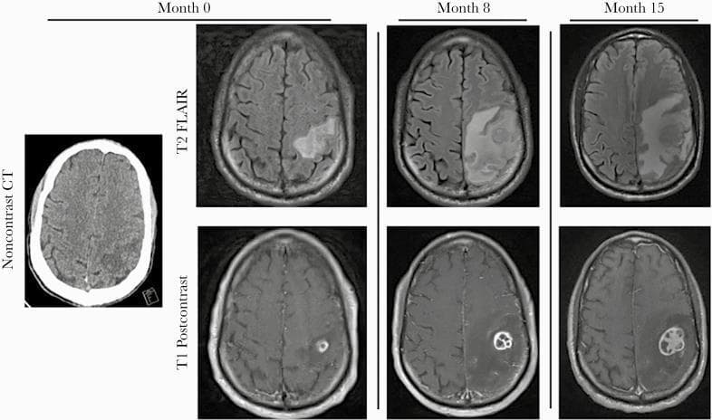 A longitudinal comparison of brain imaging across three time points (Month 0, 8, and 15) using noncontrast head CT, T2-weighted fluid-attenuated inversion recovery (FLAIR) MRI, and T1-weighted post-contrast MRI. The axial images focus on a progressive intracranial lesion in the left parietal lobe. At Month 0, the CT and MRI show a small rim-enhancing lesion with mild surrounding vasogenic edema. By Month 8, the T2 FLAIR sequence demonstrates a significant increase in hyperintense signal indicating worsening vasogenic edema, while the T1 post-contrast scan reveals a larger, multiloculated rim-enhancing mass. By Month 15, the lesion exhibits further expansion with a complex, internal honeycomb-like multilocular enhancement pattern. The associated T2 FLAIR hyperintensity shows extensive progression across the left hemisphere, causing mass effect with sulcal effacement and a developing midline shift. This radiographic series illustrates the evolution of a parietal abscess and secondary inflammatory changes, such as Immune Reconstitution Inflammatory Syndrome (IRIS), in the context of advanced HIV/AIDS.