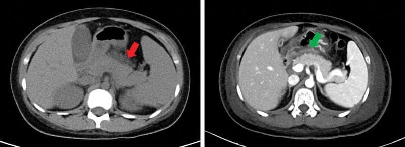 This abdominal computerized tomography (CT) scan consists of two axial views demonstrating features of acute pancreatitis and associated complications. The image on the left, a non-contrast CT, features a red arrow indicating a swollen, heterogeneously dense pancreas with peripancreatic fat stranding and indistinct margins, signs characteristic of acute inflammation. The image on the right is a contrast-enhanced CT where the green arrow points to a significant collection of low-density fluid in the anterior pararenal space and abdominal cavity, consistent with hydrops abdominis or peripancreatic fluid collection. Anatomical landmarks include the liver on the right side of the image, the spleen on the left, and the stomach located anteriorly to the pancreas. The contrast scan clearly delineates the vasculature and reinforces the presence of extensive peritoneal fluid and inflammatory changes surrounding the pancreatic head and body. These findings are clinically relevant for diagnosing systemic complications of autoimmune conditions like Systemic Lupus Erythematosus (SLE) affecting the gastrointestinal system.
