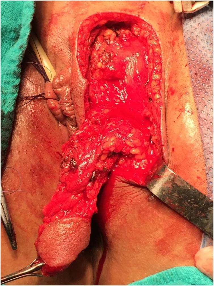 This clinical photograph captures an intraoperative view of a pedicled labial skin flap (Martius flap) being harvested for reconstructive surgery, likely for rectovaginal fistula repair. The image shows the inner aspect of the left labium majus where an elongated skin flap, approximately 4–5 cm in length, has been surgically dissected. The flap is pedicled, maintaining its vascular supply through a broad base (meso), allowing for mobilization without tension into the vaginal or rectal area. The distal end of the flap displays a smooth epithelial surface, while the underlying deep surface is granular, showing exposed subcutaneous adipose tissue and minor surgical bleeding. The donor site reveals deep perineal tissues, including muscle and fat, with a metal surgical retractor positioned to the right to maintain exposure. Sutures and surgical instruments are visible at the periphery, and anatomical landmarks like the clitoris are partially visible within the operative field. This visual demonstrates the surgical anatomy and mobilization phase of a pedicled fat/skin graft in gynecological or colorectal reconstructive procedures.