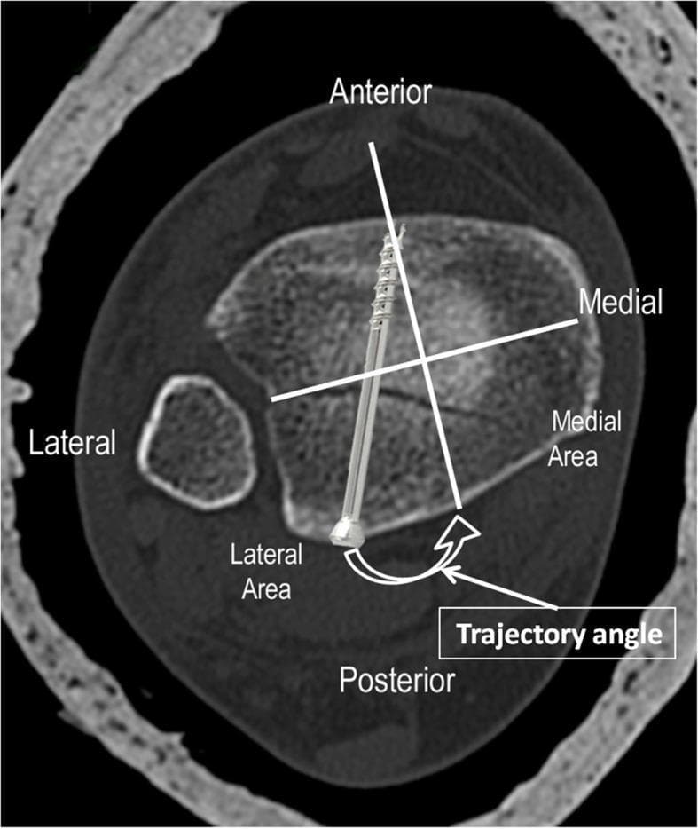 This diagnostic axial CT scan image of the distal tibia and fibula demonstrates a postero-lateral type posterior malleolar fracture being stabilized with internal fixation. The image is annotated with anatomical landmarks (Anterior, Posterior, Medial, Lateral) and a four-quadrant grid system. A horizontal bimalleolar reference line and a perpendicular vertical line divide the posterior malleolus into medial and lateral areas. A metallic cannulated lag screw is seen traversing the distal tibia from an anterior-to-posterior direction, specifically targeting the fracture fragment in the posterolateral quadrant. The image highlights the 'Trajectory Angle,' which is the angle between the screw's path and the perpendicular reference line. This educational diagram illustrates the optimal surgical planning and trajectory for percutaneous screw fixation of posterior malleolar fragments based on CT classification. The fibula is visible lateral to the tibia, and the cortical bone of the tibia shows the insertion point of the hardware relative to the medial malleolus and the Chaput tubercle.