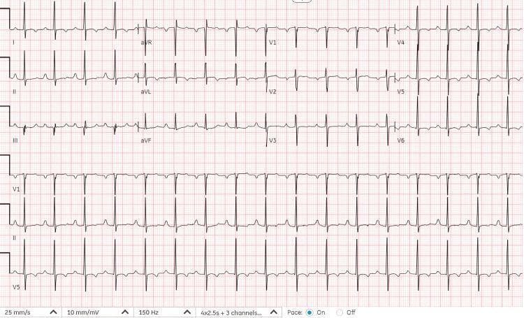 A standard 12-lead electrocardiogram (ECG) displayed on a grid with a paper speed of 25 mm/s and voltage of 10 mm/mV. The tracing demonstrates sinus tachycardia with a heart rate of approximately 105 beats per minute. P waves are present and consistently associated with a narrow QRS complex, suggesting a normal cardiac conduction pathway. The R-R intervals are regular throughout the recording, indicating a stable rhythm without arrhythmias or ectopic beats. Notable morphological features include non-specific T-wave changes in the lateral leads (I, aVL, V5, V6), which are characterized by slight flattening or subtle variations in shape. The precordial leads show normal R-wave progression from V1 to V5. This diagnostic image represents a follow-up ECG following rewarming in a patient with previous hypothermia-related changes, showing the resolution of Osborn (J) waves and first-degree atrioventricular block, returning to a baseline clinical state.