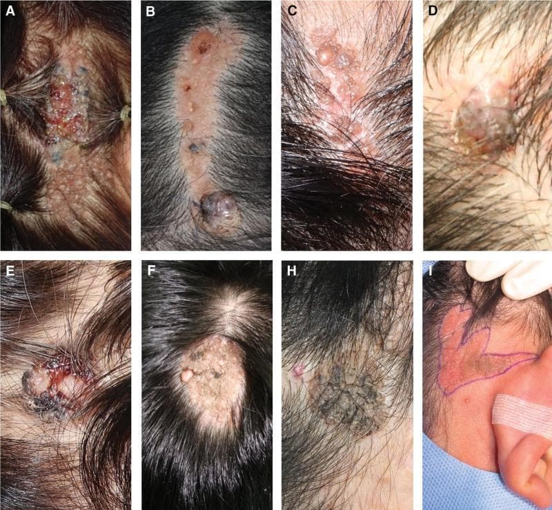 This composite clinical photograph displays a series of scalp lesions illustrating the malignant transformation of Nevus Sebaceous (NS) into Basal Cell Carcinoma (BCC). The images demonstrate varied morphological presentations: (A) and (B) show linear, brownish, and yellowish alopecia plaques with superimposed blackish pigmented nodules and focal ulcerations. (C) and (F) illustrate classic NS features including verrucous, yellowish-tan plaques with a characteristic cobblestone or mammillated surface. (D) and (E) highlight suspicious morphological changes such as rapid size expansion, protruding masses, and hemorrhagic crusting. (H) shows a densely textured, dark pigmented plaque. (I) provides a surgical perspective with preoperative markings for wide excision of a large, irregular plaque on the temporal scalp. These images emphasize the clinical indicators of malignant degeneration within a pre-existing congenital lesion, specifically targeting the transition from benign epidermal/sebaceous hyperplasia to invasive basaloid cell nests. The collection serves as an educational reference for dermatologic oncology and surgical planning for scalp adnexal tumors.
