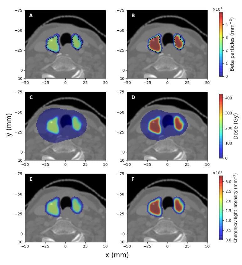 A comparison chart of clinical diagnostic images illustrating the spatial distribution of I-131 radioactive decay products in hyperthyroidism treatment. The images are displayed in a trans-axial plane (z=-50.6 mm) and organized into two columns representing administered activities of 400 MBq (left) and 700 MBq (right). Row 1 (A, B) shows beta particle concentration ($mm^{-3}$), with high intensity localized strictly within the bilateral thyroid lobes, demarcated by dotted contours. Row 2 (C, D) depicts the absorbed dose (Gy), demonstrating a broader spatial distribution that extends slightly beyond the thyroid lobes due to bremsstrahlung and gamma radiation. Row 3 (E, F) displays spectrally-integrated emitted Cherenkov light intensity ($mm^{-3}$), showing a localization pattern highly similar to beta particles but with distinct intensity scales. The 700 MBq group shows proportionally higher signal intensities across all parameters compared to the 400 MBq group. These simulations highlight the relationship between Cherenkov light emission and absorbed dose for molecular radiotherapy dosimetry.