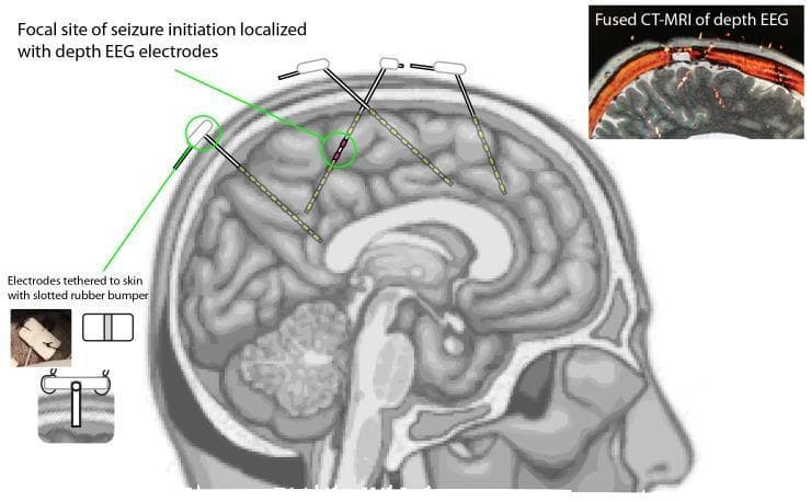 This medical illustration and diagnostic composite demonstrate the use of depth EEG electrodes for localizing a seizure focus in epilepsy management. The primary central image is a sagittal anatomical diagram of the human brain showing four implanted depth electrodes traversing the cortex and subcortical regions. One electrode is highlighted with a green circle, showing red contacts that indicate the focal site of seizure initiation, while non-active contacts on other electrodes are shown in yellow. An upper-right inset displays a 'Fused CT-MRI of depth EEG,' illustrating the radiological correlation of electrode placement within the skull. A lower-left inset provides a technical diagram and clinical photograph detailing the anchoring method, where electrodes are tethered to the scalp using a slotted rubber bumper, staples, and sutures. This visual resource is intended for neurosurgical and neurological education, specifically regarding Phase 2 stereoelectroencephalography (SEEG) and pre-surgical planning for focal epilepsy treatments such as resection or responsive neurostimulation.