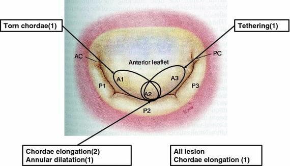 This medical illustration depicts an anatomical diagram of the mitral valve from an atrial perspective, detailing the segmental anatomy and associated valvular pathologies related to mitral regurgitation. The anterior leaflet is divided into segments A1, A2, and A3, while the posterior leaflet shows segments P1, P2, and P3. The anterior commissure (AC) and posterior commissure (PC) are also marked. The diagram maps specific structural etiologies to these segments: 'Torn chordae' near the AC/P1 area; 'Chordae elongation' and 'Annular dilatation' at the P2/A2 segment; and 'Tethering' near the PC/P3 region. A generalized note for 'All lesion chordae elongation' is also included. This visual summarizes Carpentier’s functional classification, illustrating how specific subvalvular and annular abnormalities contribute to mitral valve dysfunction. It serves as an educational tool for cardiology and cardiothoracic surgery to understand the spatial distribution of mitral apparatus pathologies.