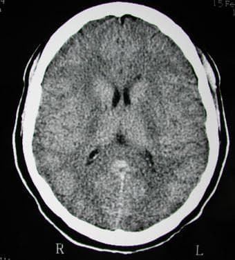 This diagnostic axial non-contrast CT scan of the brain demonstrates classic findings of diffuse cerebral edema. The image reveals a generalized loss of grey-white matter differentiation throughout the cerebral hemispheres, with the brain parenchyma appearing abnormally hypodense. Significant mass effect is evident through the near-complete effacement of the cortical sulci and cisterns, creating a 'smooth' appearance of the brain surface. The ventricular system, including the lateral and third ventricles, appears slit-like and severely compressed due to the increased intracranial pressure and global tissue swelling. These radiological features are characteristic of significant intracranial hypertension and global hypoxic-ischemic injury or inflammatory processes, such as the hypersensitivity syndrome described in the clinical context. The scan is a primary educational example of how acute cerebral swelling alters normal neuroanatomical landmarks on computed tomography.
