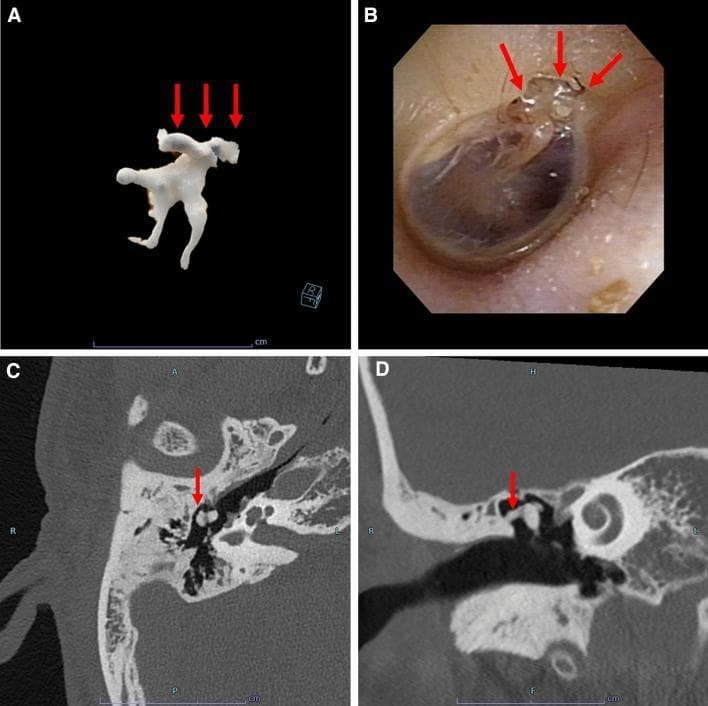 A multi-panel clinical and diagnostic figure demonstrating tympanosclerosis in the middle ear of an adult patient. (A) 3D volumetric reconstruction of the ossicular chain, showing irregular, calcified deposits (red arrows) integrated into the superior aspect of the ossicles. (B) Otoscopic clinical photograph of the tympanic membrane, revealing characteristic white, chalky plaques (red arrows) indicative of myringosclerosis/tympanosclerosis in the superior portion of the drum. (C) Axial high-resolution computed tomography (CT) scan and (D) coronal CT scan of the temporal bone. Both radiological views demonstrate discrete, irregular, high-density (hyperattenuating) calcifications within the tympanic cavity, specifically localized around the malleus and incus (red arrows). These findings represent the hyalinization and subsequent calcification of connective tissue within the middle ear and tympanic membrane, typically a sequela of chronic otitis media. The density of the lesions on CT is comparable to that of cortical bone.
