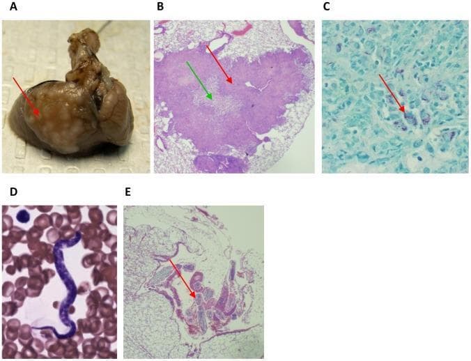 Educational histological and clinical composite illustrating coinfection with Mycobacterium tuberculosis and Litomosoides sigmodontis. Panel A: Macroscopic clinical photograph of lung tissue featuring distinct superficial granulomatous lesions (red arrow). Panel B: H&E stained light microscopy (40x) of a pulmonary granuloma (red arrow) exhibiting a characteristic necrotic core (green arrow) and surrounding inflammatory infiltrate. Panel C: High-magnification acid-fast stain (100x) identifying acid-fast bacilli (M. tuberculosis) appearing as slender red rods (red arrow) within the tissue. Panel D: Peripheral blood smear (Eosin-Y Azure A Methylene Blue, 100x) showing a slender, basophilic microfilaria of L. sigmodontis amidst erythrocytes. Panel E: H&E stained lung cross-section (40x) demonstrating an adult L. sigmodontis nematode (red arrow) situated within the pleural space. This collection highlights diagnostic features of tuberculosis granulomas, acid-fast staining techniques, and the morphological differentiation between microfilarial and adult stages of filarial parasites in various anatomical compartments.