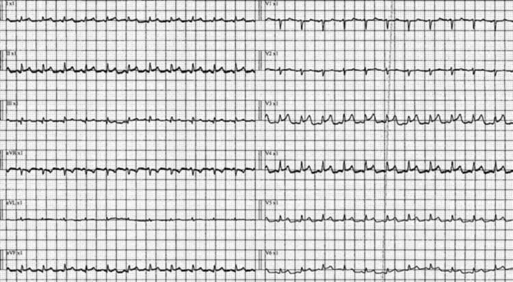 Diagnostic Image: A 12-lead electrocardiogram (ECG) displayed on a standard grid, demonstrating key pathological findings consistent with acute pericarditis. The tracing shows a narrow complex sinus tachycardia with a notably shortened PR interval. There is widespread, concave (upward) diffuse ST-segment elevation visible across multiple limb leads (I, II, aVL, aVF) and precordial leads (V2-V6). Corresponding ST-segment depression is noted in lead aVR, which is a classic reciprocal change in pericarditis. T-wave abnormalities are present, including varying morphology such as flattening or peaking that does not consistently correlate with QRS polarity. Low voltage may be present in the limb leads. This ECG serves as a primary educational example of inflammatory cardiac involvement, illustrating the transition from isoelectric lines to diffuse ST-segment changes that do not follow a specific coronary artery territory, distinguishing it from localized myocardial infarction.