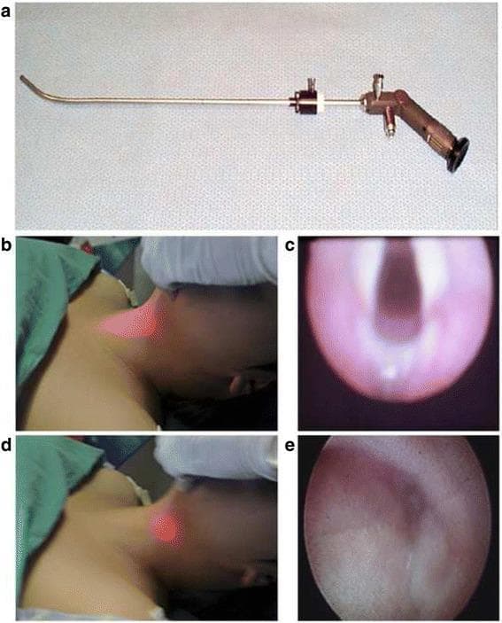 This composite educational image illustrates the transillumination-assisted intubation technique using a Bonfils optical stylet. Panel (a) shows the medical device, a rigid, slender optical stylet with a curved distal tip and a proximal eyepiece and light source connector. Panels (b) through (e) demonstrate clinical application and endoscopic correlation. Image (b) shows a centered, bright transillumination light on the anterior neck, indicating the stylet tip is positioned correctly at the midline. This corresponds to the endoscopic view in (c), which clearly depicts the laryngeal inlet, including the vocal cords and glottis. In contrast, image (d) displays a darker, laterally deviated light spot on the neck. The associated endoscopic view in (e) shows non-target anatomy, such as the pyriform sinus and pharyngeal walls, indicating the stylet is off-axis. This figure teaches clinicians how to use external visual cues (transillumination) to guide internal airway visualization, facilitating successful tracheal intubation by aligning the device with the glottic opening.