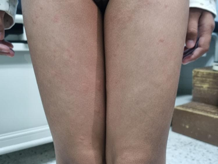 Clinical photograph of a pediatric patient's bilateral lower limbs demonstrating classic urticaria (hives). The image shows multiple discrete and confluent wheals distributed across the thighs. Morphologically, the lesions are characterized by raised, edematous, superficial swellings of varying sizes. The central portions of the wheals appear pale or skin-colored, while the peripheries exhibit varying degrees of erythema. These findings represent a type I hypersensitivity reaction or mast cell degranulation, leading to dermal edema. This visual evidence is a key diagnostic clinical sign for acute urticaria, commonly used in dermatology and pediatric curricula to differentiate transient wheals from other types of papular eruptions or inflammatory skin conditions.