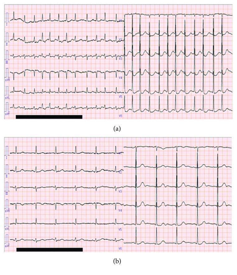 A comparative presentation of two 12-lead electrocardiogram (ECG) tracings from the same patient, demonstrating spontaneous rhythm alternation. (a) Top tracing: ECG showing atrial fibrillation (AF) characterized by an irregularly irregular rhythm, high ventricular rate, and the absence of discernible P waves. Fibrillatory waves are most prominent in the precordial leads (V1-V6), while the limb leads show inconsistent baseline morphology. (b) Bottom tracing: ECG demonstrating a return to normal sinus rhythm (SR). This tracing displays a regular rhythm with a slower heart rate, consistent R-R intervals, and clear P waves preceding each QRS complex across all leads (I, II, III, aVR, aVL, aVF, and V1-V6). The QRS complexes maintain similar morphology in both states. This visual comparison illustrates the diagnostic criteria for paroxysmal atrial fibrillation and its conversion to sinus rhythm in a clinical setting.