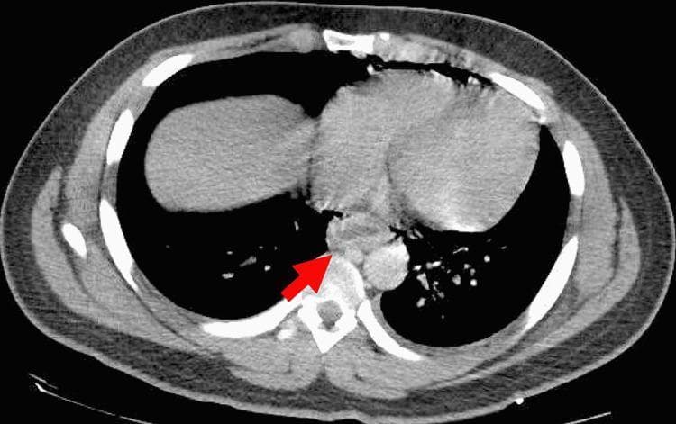 This diagnostic image is a transverse (axial) view computed tomography (CT) scan of the human chest, presented in a soft tissue/mediastinal window. Key anatomical landmarks include the lungs (appearing as dark, air-filled lateral spaces), the central mediastinum containing the heart and great vessels, and the posterior thoracic spine. A red arrow highlights a significant pathological finding in the posterior mediastinum: diffuse circumferential thickening of the esophageal wall with associated soft tissue stranding and irregularity. There is evidence of pneumomediastinum, characterized by pockets of low-density gas tracking adjacent to the esophageal margins and behind the heart. These radiological signs are highly indicative of an esophageal perforation, such as that seen in Boerhaave syndrome (effort rupture of the esophagus). The image demonstrates the critical role of CT imaging in identifying emergency gastrointestinal tract disruptions and evaluating secondary complications like mediastinitis or pneumomediastinum within a clinical setting.