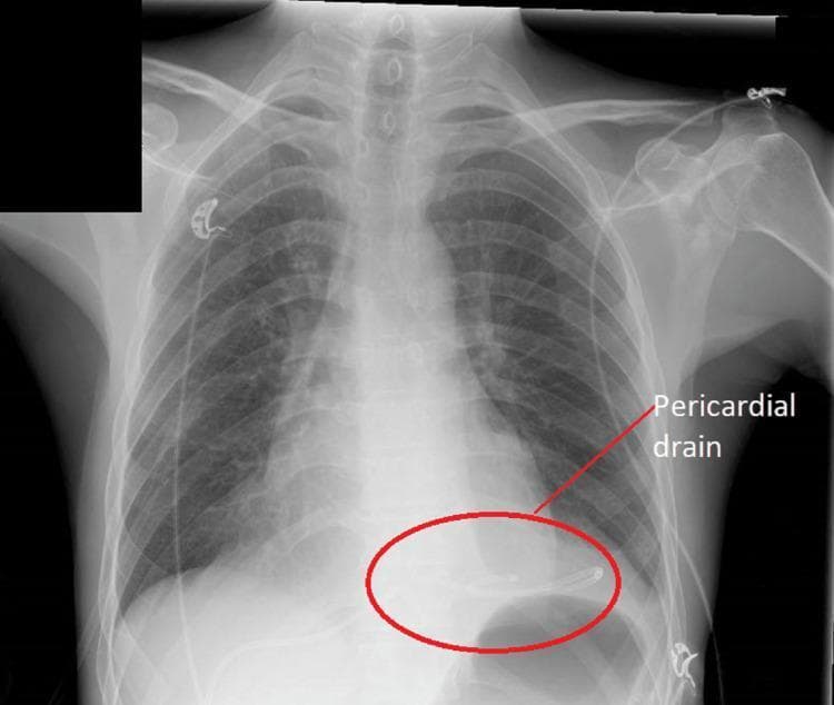 This diagnostic image is an anteroposterior (AP) chest X-ray demonstrating the post-procedural state of a patient following the drainage of a large pericardial effusion. The central focus is the cardiac shadow, which shows a significant reduction in the cardiothoracic ratio compared to typical 'water bottle' heart configurations seen in tamponade. A radiopaque pericardial drain is clearly visible and highlighted by a red oval and label in the lower left cardiac region (anatomical right side of the heart silhouette). The drain's distal pigtail or curved tip is positioned within the pericardial space to facilitate continuous drainage. The surrounding lung fields are clear, with no visible pulmonary edema, pleural effusion, or infiltrates, suggesting stable respiratory status. Several external ECG leads are visible on the chest wall. This visual serves as an educational tool for identifying the radiological signs of effective pericardiocentesis and the proper positioning of a subcostal pericardial drainage catheter.