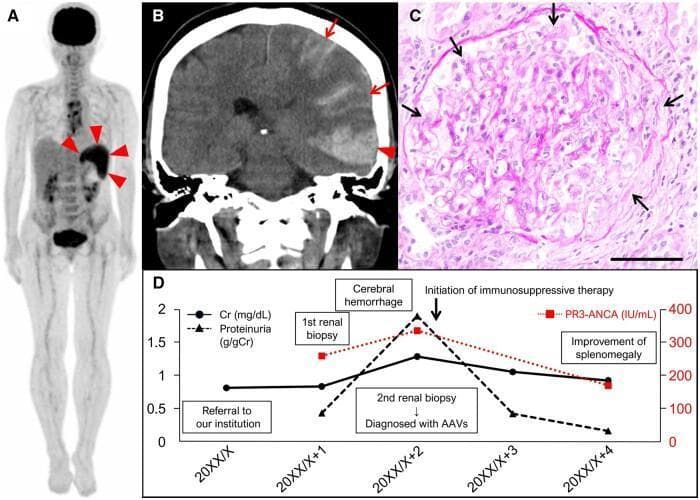 This composite educational graphic illustrates the multi-system manifestations and clinical course of Anti-Neutrophil Cytoplasmic Antibody (ANCA)-associated vasculitis (AAV). (A) Whole-body FDG-PET scan demonstrates intense radioactive tracer uptake (arrowheads) localized to the spleen, indicating pathological metabolic activity in a patient presenting with splenomegaly. (B) Coronal non-contrast brain CT scan shows acute hyperdense areas consistent with intracranial bleeding. An arrowhead indicates a subcortical hemorrhage in the left temporal lobe, while arrows highlight adjacent subarachnoid hemorrhage. (C) High-magnification (200x) histopathological micrograph of a renal biopsy using Periodic acid-Schiff (PAS) stain. Arrows delineate the formation of a cellular crescent within Bowman’s space, diagnostic of crescentic glomerulonephritis. (D) A longitudinal clinical graph correlates laboratory markers—creatinine (Cr), proteinuria, and proteinase 3 (PR3)-ANCA levels—with major clinical events, demonstrating the progression to renal failure and cerebral hemorrhage followed by improvement after initiating immunosuppressive therapy. The image highlights the diagnostic triad of splenic involvement, central nervous system hemorrhage, and rapidly progressive glomerulonephritis in systemic vasculitis.