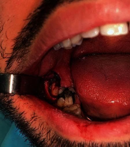 This clinical photograph captures an intraoral surgical procedure involving the extraction of an impacted third molar. The image shows the posterior region of the mandible, where a full-thickness mucoperiosteal flap (triangular Archer's flap) has been reflected to expose the surgical site. A metallic retractor is positioned to hold back the buccal mucosa, providing clear visualization of the mandibular alveolar ridge. An osteotomy has been performed to remove the buccal bone surrounding the crown of the impacted tooth, which is visible in the extraction socket before total removal. There is moderate bleeding and mild inflammation evident in the surrounding gingival tissues, consistent with acute surgical intervention. Adjacent erupted teeth are visible, with one showing potential restorative material. The tongue is lateralized to prevent interference with the surgical field. This image serves as an educational example of intraoral surgical techniques for tooth extraction, highlighting soft tissue management and buccal bone removal via osteotomy.