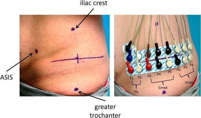 Clinical photograph in two panels demonstrating the standardized application of surface electromyography (SEMG) electrodes on the right gluteal region. The left panel shows surface anatomical landmarks marked with black dots: the anterior superior iliac spine (ASIS), iliac crest, and greater trochanter. A vertical reference line connects the iliac crest and greater trochanter, intersected by a horizontal marker line at the midpoint. The right panel illustrates the placement of sixteen monopolar Ag-AgCl solid gel electrode strips, labeled P1 through P8 from ventral to dorsal. These are organized into functional muscular groups: P1-P2 correspond to the tensor fasciae latae (TFL), P3-P5 to the gluteus medius (Gmed), and P6-P8 to the gluteus maximus (Gmax). A separate reference electrode is positioned superior to the ASIS. Color-coded lead wires (blue, brown, red, black, and white) connect the electrodes to a measurement device. This setup is utilized for assessing hip stabilizer activity during gait analysis and functional movement.