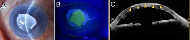 A multi-panel ophthalmological clinical image series demonstrating band keratopathy and corneal epithelial defects following Descemet's stripping automated endothelial keratoplasty (DSAEK). Panel A is a clinical photograph of the anterior segment showing a prominent, irregular, opaque, white calcified deposit in the central cornea, characteristic of dystrophic calcification. Panel B displays the same eye under cobalt blue light with fluorescein staining, revealing a large, bright green fluorescent central corneal epithelial defect corresponding to the area of calcification. Panel C is an anterior segment optical coherence tomography (AS-OCT) cross-sectional scan showing a hyperreflective band (marked with yellow arrowheads) localized to the subepithelial and anterior stromal layers, indicative of calcium phosphate deposits. The images illustrate a rare complication where persistent epithelial loss and topical phosphate-buffered steroid use contribute to rapid corneal calcification. This serves as an educational example of corneal transplant complications, the clinical presentation of band keratopathy, and the diagnostic utility of AS-OCT in characterizing stromal pathology.