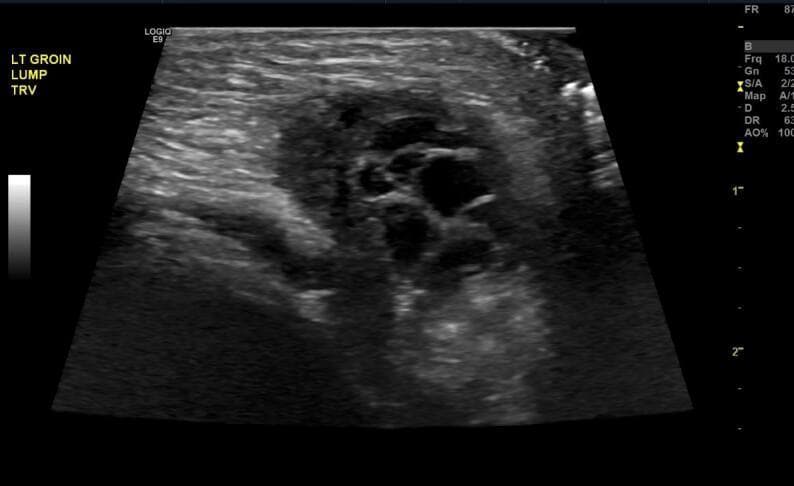 This diagnostic image is a gray-scale ultrasonography of the left groin area in a transverse (TRV) plane. The scan reveals a well-defined mass of mixed echogenicity within the inguinal canal, measuring approximately 2.1 x 1.1 cm. Central to the mass are multiple small, anechoic, circular structures consistent with ovarian follicles. The visualization of these follicles within the inguinal region is diagnostic of an incarcerated ovary within an inguinal hernia. The surrounding stromal tissue of the herniated ovary appears slightly hypoechoic compared to the adjacent hyperechoic subcutaneous fat. This image demonstrates a critical pediatric surgical emergency where normal pelvic anatomy is displaced into the inguinal canal, requiring prompt identification and reduction to prevent ovarian torsion or ischemia. Educational focus is on the sonographic recognition of ovarian tissue by its follicular pattern when evaluating a palpable inguinal lump.