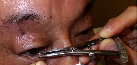 This clinical photograph demonstrates the objective assessment of horizontal eyelid laxity using the pinch test on a patient's lower eyelid. A metallic ophthalmic caliper is utilized to measure the degree of distensibility. The lower eyelid margin is being manually pinched and pulled anteriorly away from the globe. The caliper's tips are positioned to measure the precise distance between the eyeball (specifically the corneal limbus below the pupil) and the displaced lower eyelid margin. The surrounding periocular skin shows signs of chronological aging, including rhytids and solar lentigines, and a small pigmented lesion is noted near the lateral canthus. This procedural image illustrates a key diagnostic step in the evaluation of conditions such as involutional ectropion or entropion, where assessing the integrity of the medial and lateral canthal tendons and the overall tightness of the eyelid is essential for surgical planning.