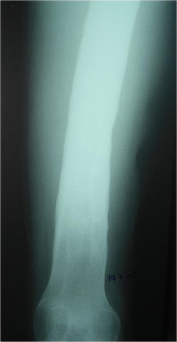 This diagnostic X-ray displays a long bone segment, likely the femur, demonstrating hallmark signs of Type C childhood chronic haematogenous osteomyelitis (CCHOM) according to the Beit CURE classification. The primary radiological feature is diffuse, dense sclerosis involving a significant portion of the diaphysis and metaphysis. The bone appears uniformly radiopaque with a loss of the normal corticomedullary differentiation, indicating extensive reactive bone formation. Notably, there is an absence of visible sequestra (detached necrotic bone fragments) or discrete involucrum formations on this plain radiograph. The cortical margins appear thickened and irregular. This pattern represents a late-stage manifestation of chronic infection where the bone has responded with generalized osteosclerosis. While not explicitly visible as a radiolucent area in this specific view, the clinical context of Type C classification suggests that an intraosseous abscess may frequently coexist with these sclerotic changes. This image serves as a teaching example for identifying advanced sclerotic responses in pediatric chronic bone infections.