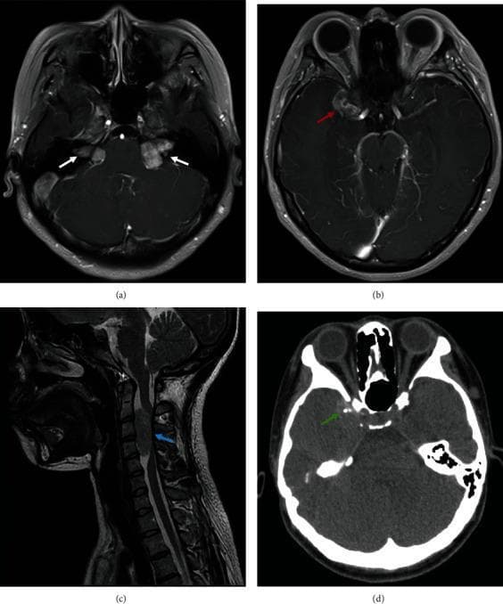 This composite figure presents multi-modal neuroimaging findings diagnostic of Neurofibromatosis Type 2 (NF2). (a) Axial contrast-enhanced MRI demonstrates pathognomonic bilateral, well-defined, intensely enhancing solid masses in the cerebellopontine angles (white arrows), consistent with vestibular schwannomas. (b) Axial enhanced MRI shows an enhancing parasellar lesion (red arrow) adjacent to the right cavernous sinus, suggestive of a meningioma. (c) Sagittal T2-weighted MRI of the cervical spine reveals an intramedullary or extramedullary hypointense focal abnormality at the C2-C4 level (blue arrow), representing a spinal cord tumor such as an ependymoma or schwannoma. (d) Non-contrast axial CT scan of the brain identifies small, hyperdense calcified lesions in the right temporal lobe (green arrow) and confirms normal contours of the bilateral optic nerves. These combined findings—bilateral acoustic neuromas, intracranial meningiomas, and spinal lesions—provide a comprehensive visual summary of the central nervous system manifestations of NF2 in a young patient.