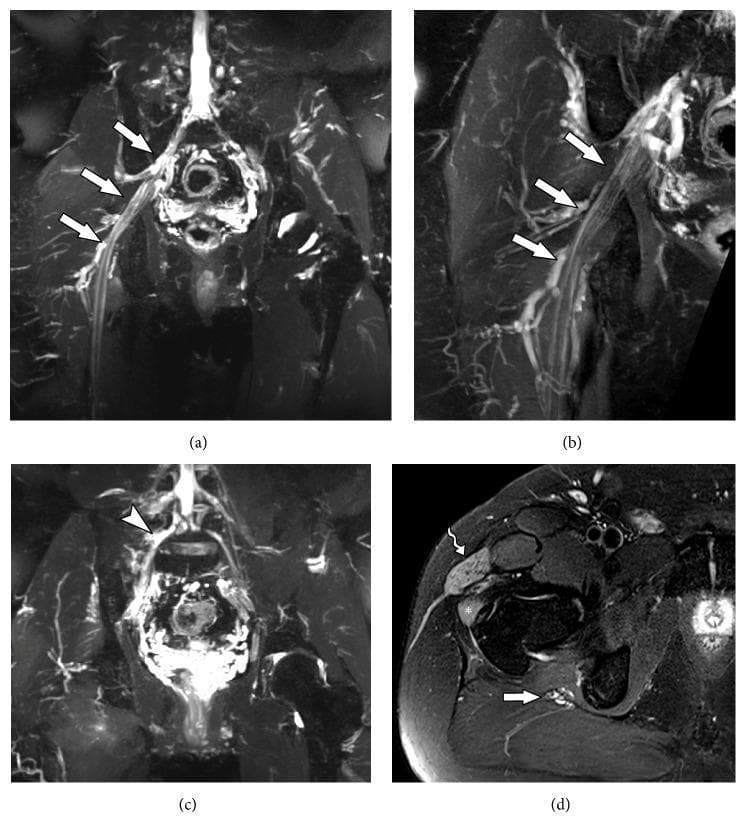 This set of four Magnetic Resonance Neurography (MRN) images illustrates post-traumatic lumbosacral plexus injury and associated muscle denervation. (a) Coronal STIR 3D SPACE and (b) Coronal T2 with fat suppression demonstrate diffuse thickening and increased signal intensity of the right sciatic nerve (white arrows) extending from the lumbosacral plexus to the thigh. (c) Coronal STIR 3D SPACE shows focal thickening of a lumbar plexus trunk (white arrowhead), consistent with neural stretching or traction injury. (d) Axial T2-weighted image reveals diffuse muscle edema, characterized by hyperintense signal within the tensor fascia lata (wavy arrow) and gluteus minimus (star) muscles. This pattern of muscular edema is a secondary sign of acute denervation or neuropathy involving the superior gluteal nerve branches. These diagnostic images are clinically relevant for evaluating peripheral nerve trauma and distinguishing between structural nerve damage and secondary muscular changes in patients presenting with lower limb weakness or drop foot.