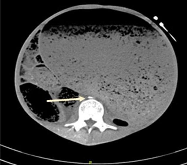 This axial computed tomography (CT) scan of the abdomen demonstrates severe abdominal compartment syndrome (ACS) resulting from massive gastric distension. The most prominent feature is a grossly dilated stomach filled with heterogeneous material and air pockets, occupying nearly the entire cross-section of the abdominal cavity. This extreme distension creates high intra-abdominal pressure, leading to significant compression of retroperitoneal vascular structures. A white arrow points to the abdominal aorta, which is severely compressed into a flattened, slit-like configuration anterior to the lumbar vertebral body. The inferior vena cava (IVC) is not visible, suggesting complete collapse due to the high extrinsic pressure. The image serves as a clinical illustration of the radiological signs of ACS, focusing on vascular compromise and visceral displacement. The anatomical relationship between the distended viscus, the spine, and the compressed major vessels is a key educational focus for understanding the pathophysiology of abdominal hypertension.