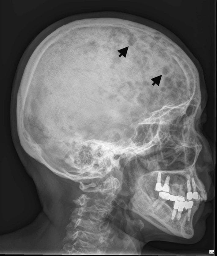 This lateral skull X-ray (radiography) demonstrates a classic 'rain-drop' or 'punched-out' appearance of the calvarium. Numerous small, well-circumscribed, round-to-oval radiolucent (darker) lytic lesions of varying sizes are scattered throughout the skull vault, particularly involving the frontal and parietal bones. These lesions show no reactive sclerotic margins, indicating rapid bone resorption typical of plasma cell dyscrasias like multiple myeloma or osteolytic metastatic disease (such as metastatic breast carcinoma). The image also captures the facial bones, upper cervical spine, and dental hardware. Multiple radiopaque dental implants and restorative work are visible in the maxilla and mandible. The overall diagnostic quality is high, highlighting key radiographic signs of systemic bone destruction for medical education in oncology and radiology.