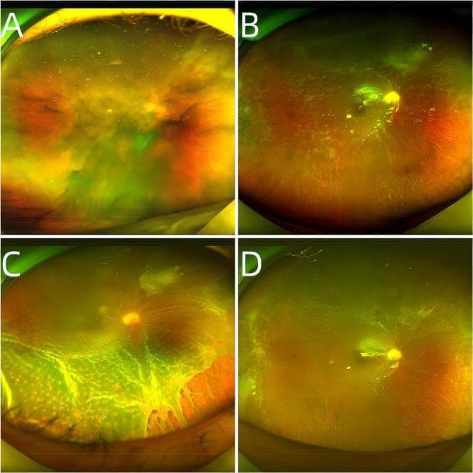 This set of four wide-field fundus photographs (labeled A-D) illustrates the progression and surgical management of Acute Retinal Necrosis (ARN) complicated by Rhegmatogenous Retinal Detachment (RRD) and Proliferative Vitreoretinopathy (PVR). Image A shows significant vitreous haze and opacity (vitritis) typical of early ARN, obscuring the posterior pole. Image B, following pars plana vitrectomy (PPV) and silicone oil tamponade, reveals widespread retinal necrosis and significant retinal vascular occlusion (vasculitis). Image C displays the fundus after silicone oil removal, characterized by severe inferior retinal detachment with extensive PVR, visible tractional bands, and retinal holes. Image D demonstrates the postoperative result after a second vitrectomy, showing a reattached, flat retina with residual peripheral proliferation and pigmentary changes from prior laser photocoagulation. This comparison highlights common complications of ARN, including PVR-induced tractional detachment following surgical intervention.