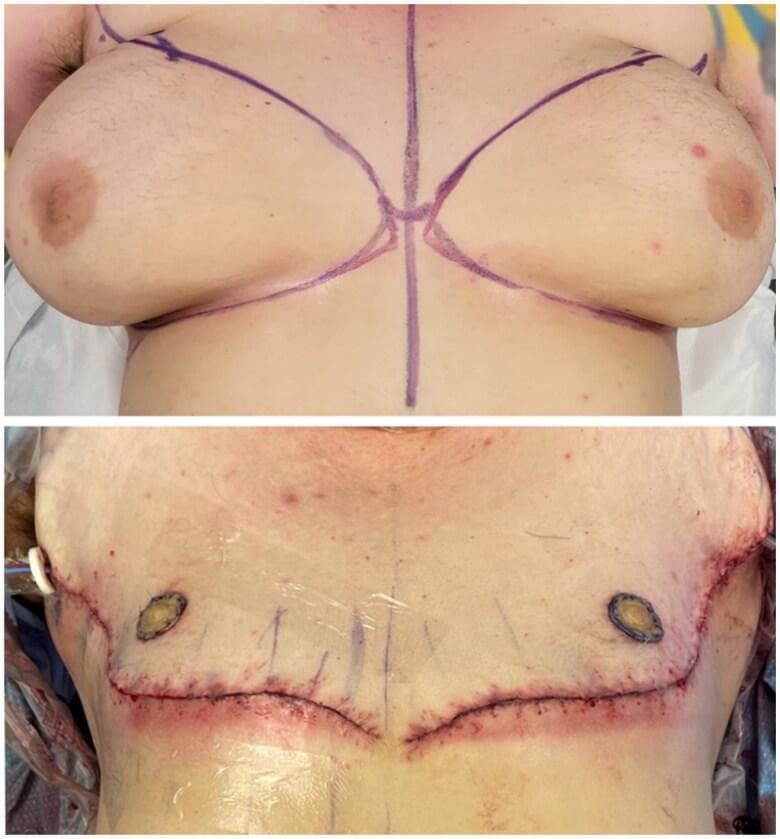 Clinical photograph comparison showing pre-operative and immediate post-operative results of a gender-affirming bilateral mastectomy. Top image: Pre-operative view of a patient with an obese body habitus and pendulous breast tissue. Purple surgical markings delineate the double-opposing incision planes, midline, and inframammary folds. Diffuse acne and scattered seborrheic keratoses are visible on the chest skin. Bottom image: Immediate post-operative result (POD 0) following subcutaneous mastectomy with free nipple grafting. The chest displays a flatter, more masculine contour with bilateral horizontal incision lines closed by sutures. Two circular free nipple grafts are visible in a superior, lateral position relative to the main incisions. A transparent occlusive dressing covers the surgical field, and a Jackson-Pratt drainage tube is visible exiting the lateral chest wall. The comparison illustrates the surgical transition from female-typical breast anatomy to a masculinized chest wall appearance as part of gender-affirming care.