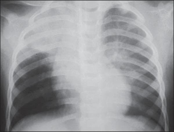 This diagnostic image is an anteroposterior (AP) chest X-ray of an 18-month-old pediatric patient. The radiograph demonstrates focal areas of increased density, specifically consolidative opacities located in the right upper lobe and the upper segment of the left lower lobe. These radiographic findings are highly characteristic of aspiration pneumonia or atelectasis occurring while the patient is in the supine (dorsal decubitus) position. The mediastinal shadow, cardiac silhouette, and diaphragmatic contours appear within normal limits for the patient's age. The skeletal structures, including the ribs and clavicles, show no fractures or deformities. The localized nature of the opacities in dependent lung segments provides significant clinical evidence for aspiration following a vomiting event, especially in the context of recovering from anesthesia. This visual serves as an educational example of typical radiographic patterns in pediatric aspiration-related pulmonary complications.