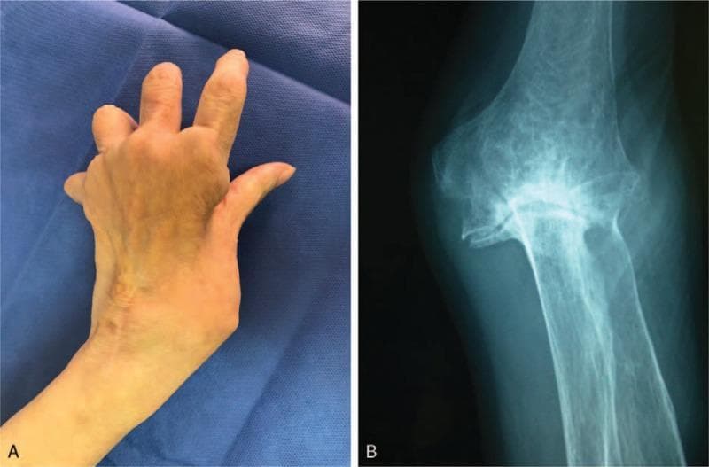 This composite educational image illustrates the clinical and radiographic features of ulnar nerve palsy in the setting of rheumatoid arthritis. Image A is a clinical photograph showing the dorsal aspect of a left hand. It demonstrates a classic 'claw hand' deformity characterized by hyperextension at the metacarpophalangeal (MCP) joints and flexion at the proximal and distal interphalangeal (IP) joints, particularly affecting the ring and small fingers. Significant atrophy of the dorsal interossei muscles is visible as hollowed depressions between the metacarpal bones. Image B is a plain anteroposterior (AP) x-ray of the corresponding elbow joint. It reveals advanced arthritic changes consistent with rheumatoid arthritis, including severe joint space narrowing, subchondral bone destruction, and marked osteophyte formation. A notable valgus deformity is present, with prominent bony projections in the medial joint space. Together, these images illustrate the correlation between joint destruction (cubital tunnel pathology) and distal neurological deficits (ulnar neuropathy).